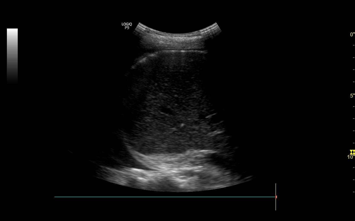 Luft Im Bauch Beim Ultraschall handsonultrasound.com
